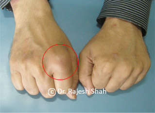 case photo demonstrating psoriatic arthritis 15150